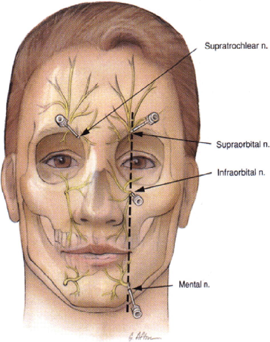 Лицевой нерв череп. Форамэн супраорбиталис. Надглазничный нерв анатомия. Тройничная невралгия блокада. Тройничный лицевой нерв.